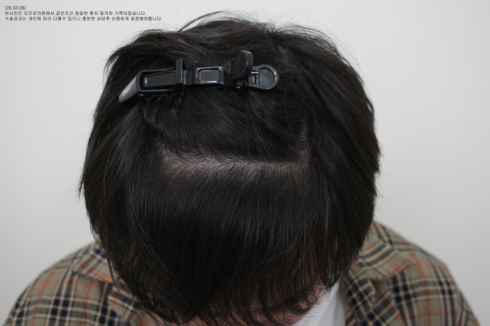施術後の症例写真